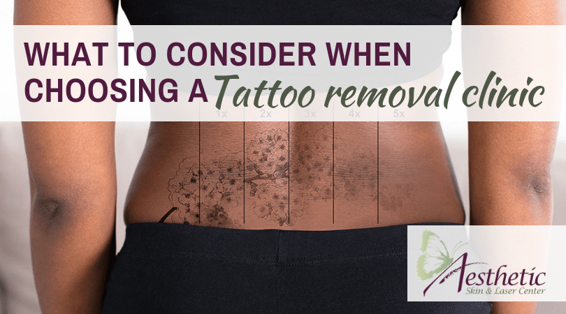 What should I consider when-choosing a tattoo removal clinic