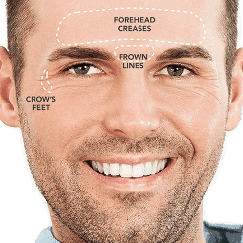 Brotox - Botox for men in Pittsburgh