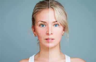 Rosacea Before & After