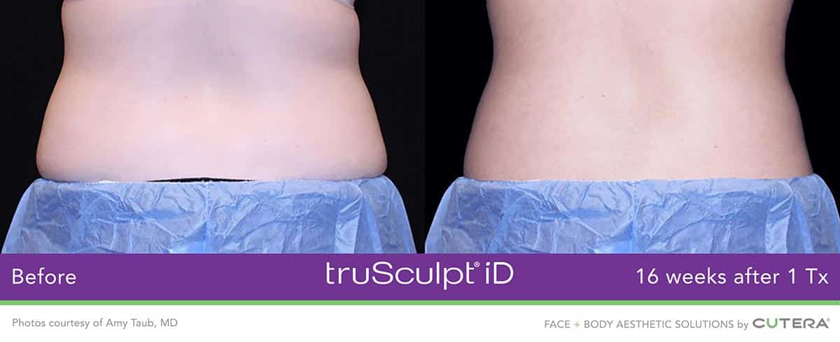 truSculpt-iD-Amy-Taub-MD-1