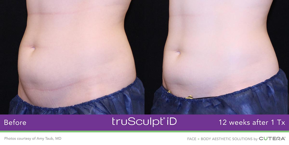 truSculpt-iD-Amy-Taub-MD-3