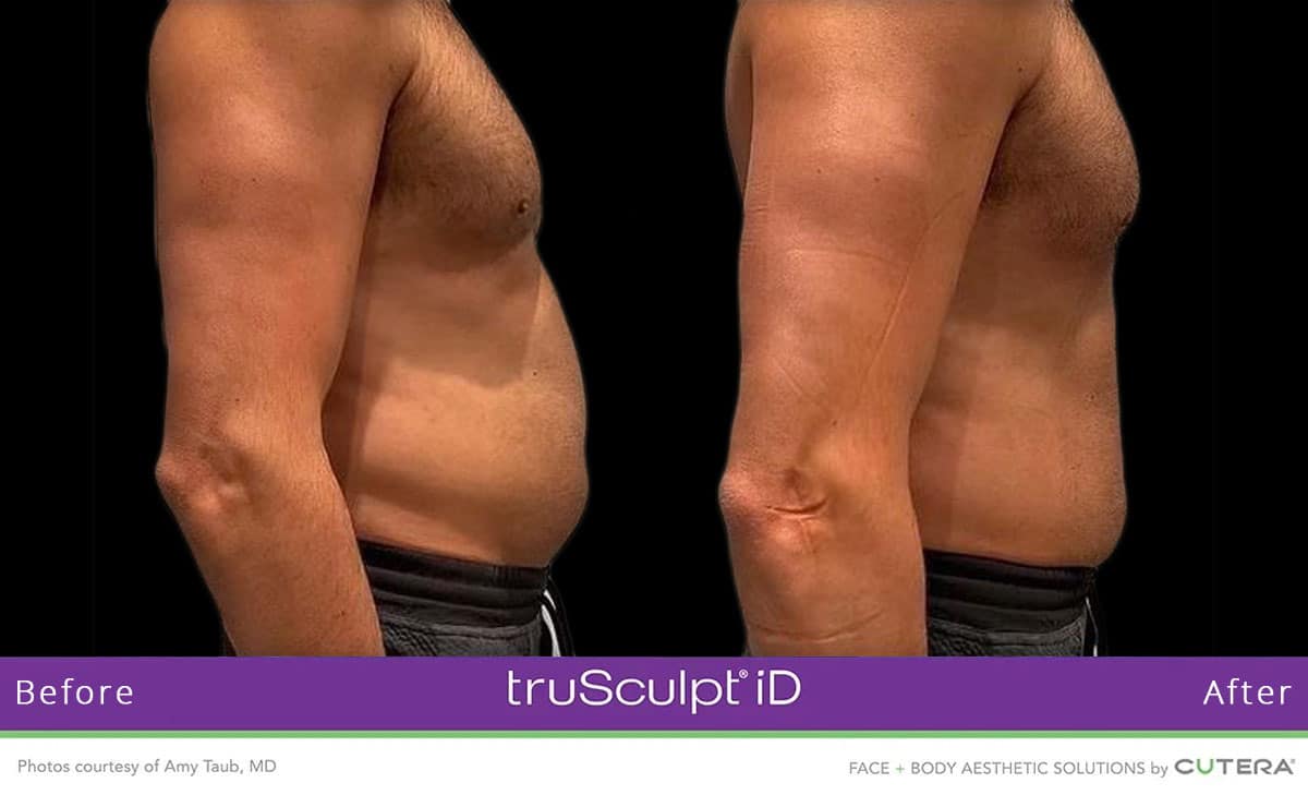 trusculpt_ba1