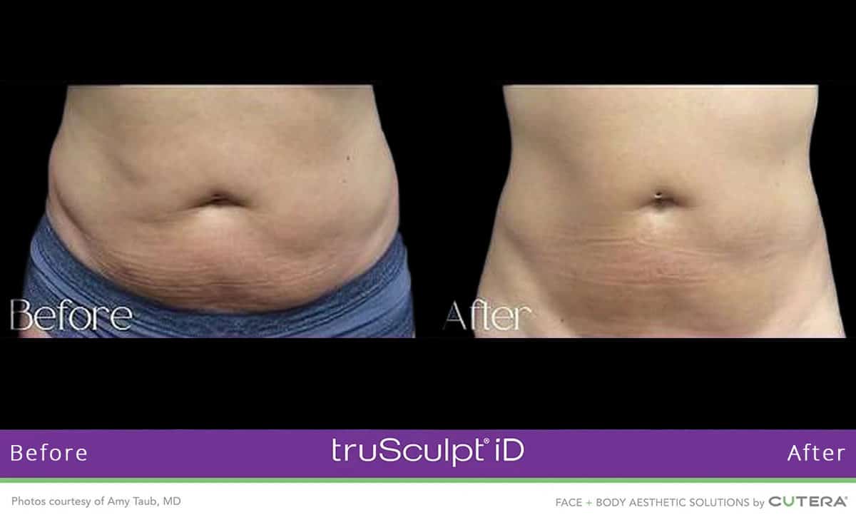 trusculpt_ba3