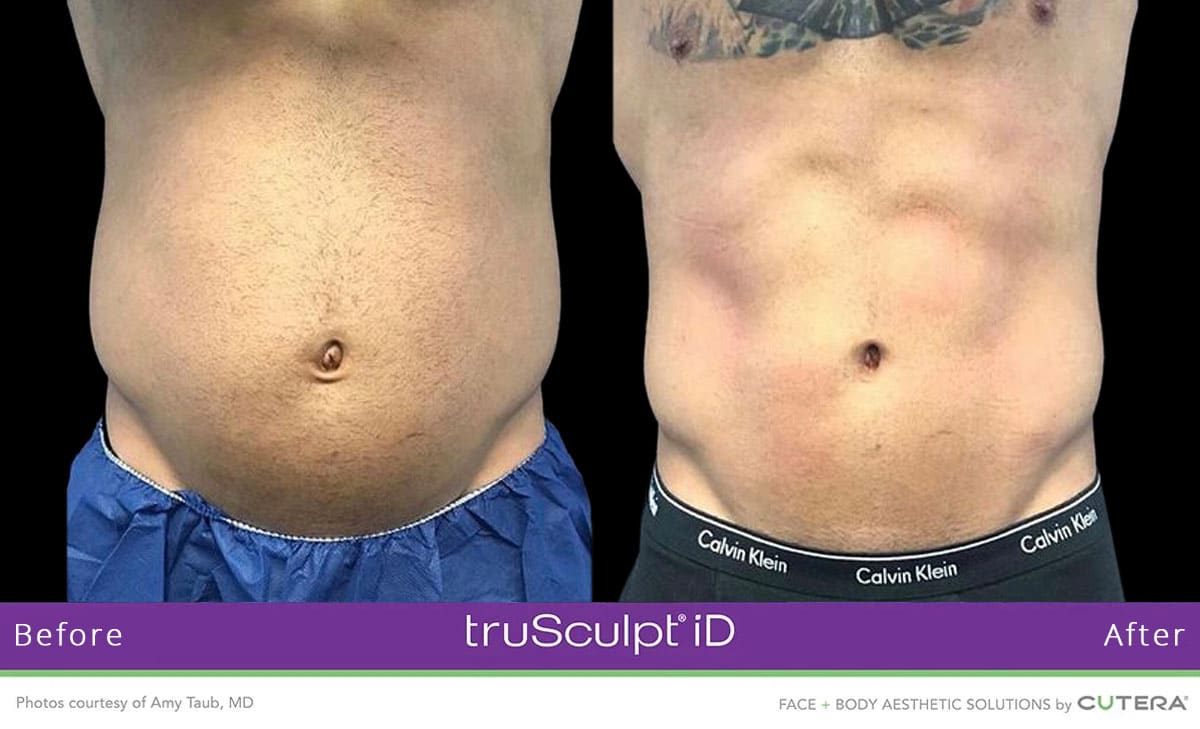 trusculpt_ba4