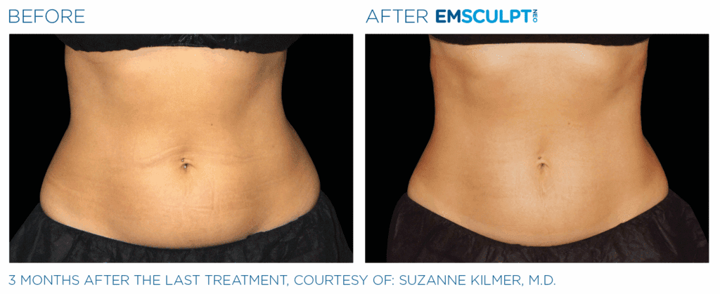 emsculpt neo body sculpting pittsburgh