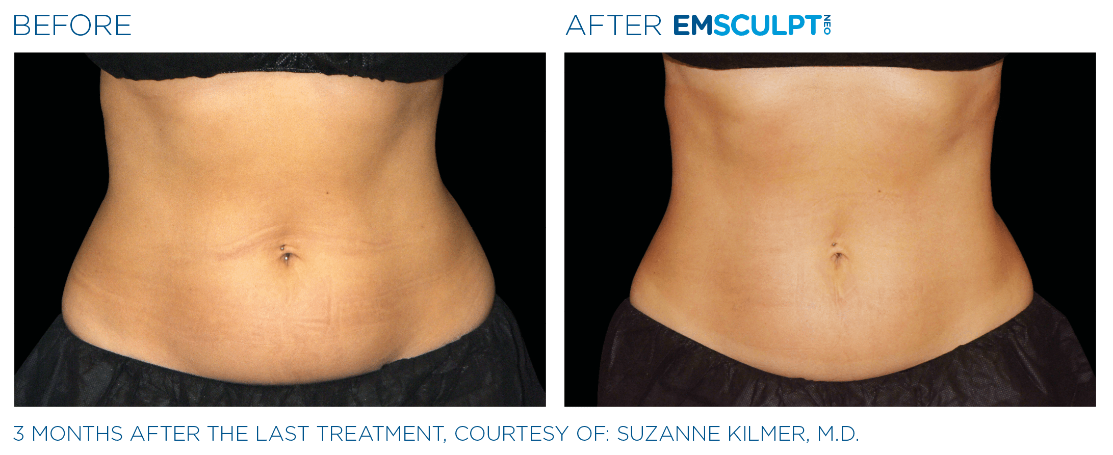 emsculpt neo body sculpting pittsburgh