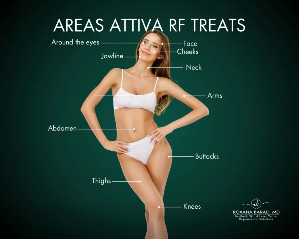 Graphic of woman with areas of body that Attiva RF treats labeled