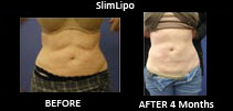 SlimLipo-Most-Popular-Areas1
